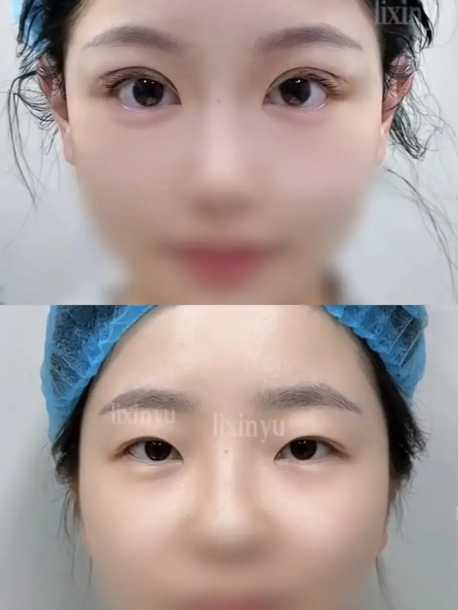 Double-eyelid surgery