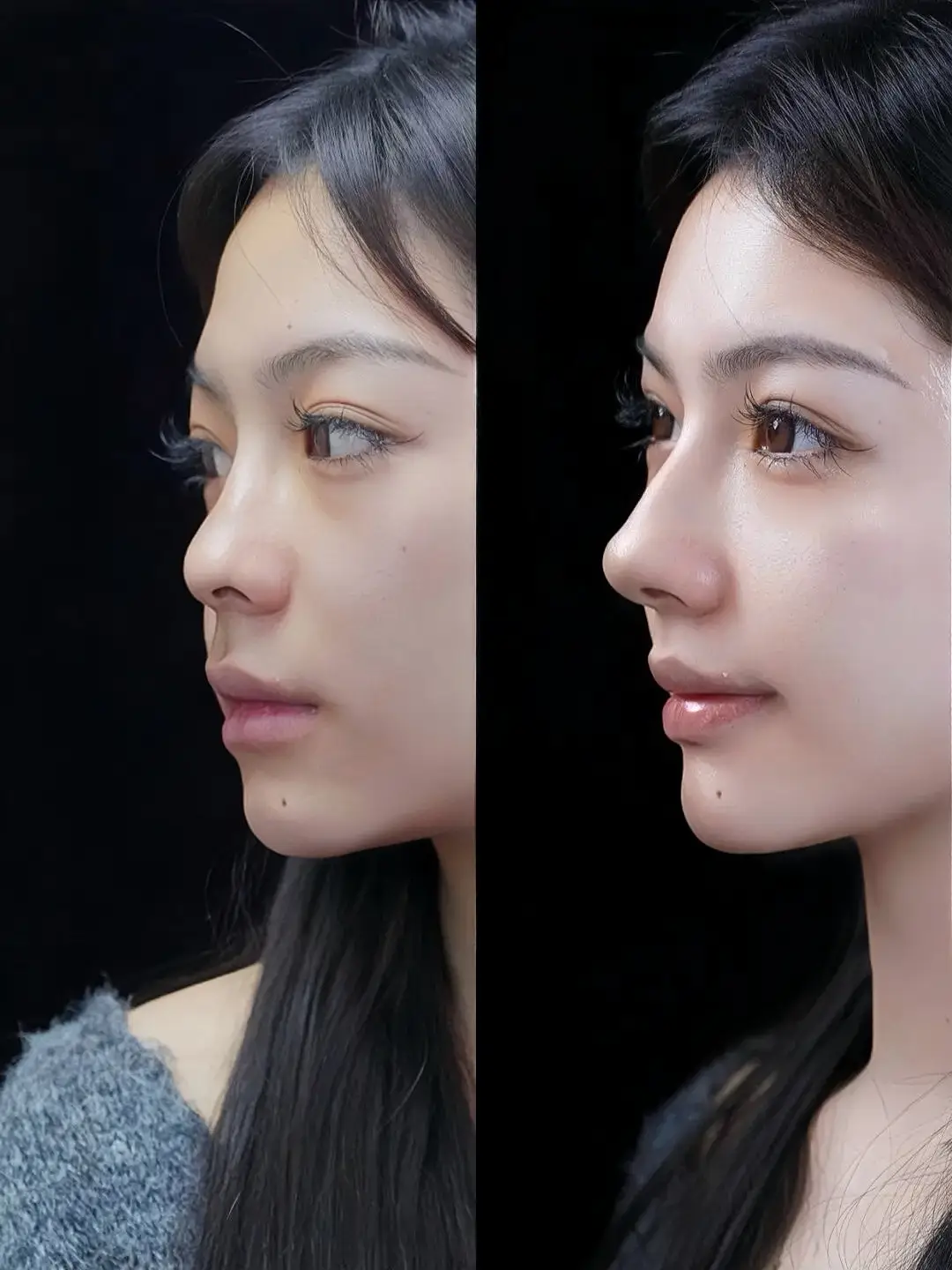 Facelift
