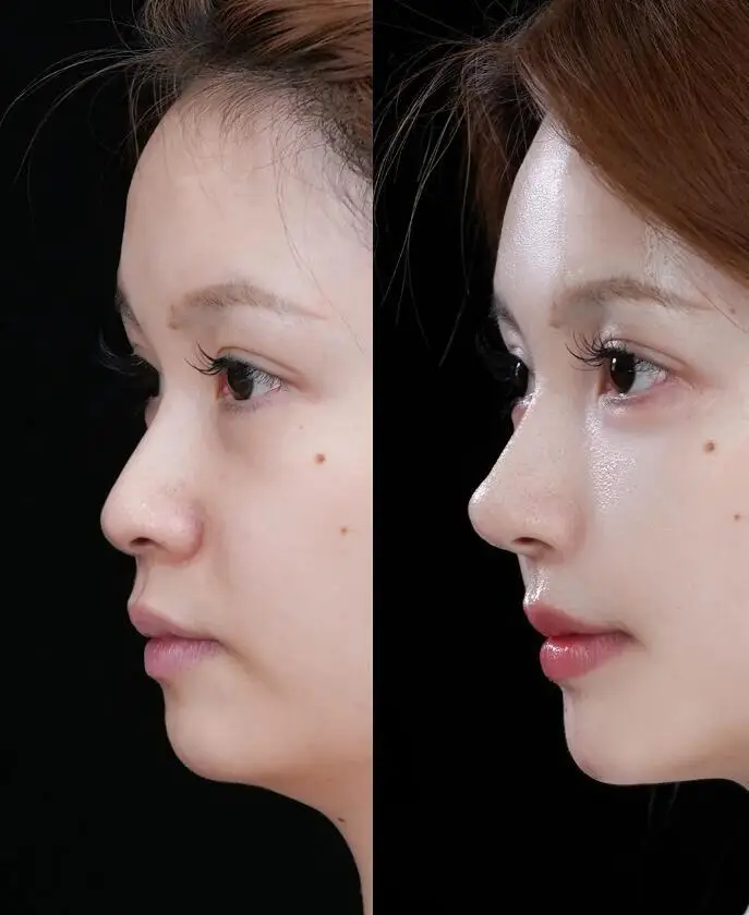 Ear-cartilage rhinoplasty